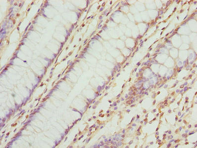 Immunohistochemistry of paraffin-embedded human colon cancer using the antibody at dilution of 1:100Rabbit anti-Human TMEM143 Polyclonal Antibody