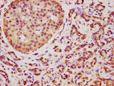 IHC image of the antibody diluted at 1:350 and staining in paraffin-embedded human pancreatic cancer performed on a Leica BondTM system. After dewaxing and hydration, antigen retrieval was mediated by high pressure in a citrate buffer (pH 6.0). Section was blocked with 10% normal goat serum 30min at RT. Then primary antibody (1% BSA) was incubated at 4°C overnight. The primary is detected by a biotinylated secondary antibody and visualized using an HRP conjugated SP system.Rabbit anti-Human TMEM14A Polyclonal Antibody