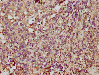 IHC image of TMEM14A Antibody diluted at 1:350 and staining in paraffin-embedded human ovarian cancer performed on a Leica BondTM system. After dewaxing and hydration, antigen retrieval was mediated by high pressure in a citrate buffer (pH 6.0). Section was blocked with 10% normal goat serum 30min at RT. Then primary antibody (1% BSA) was incubated at 4°C overnight. The primary is detected by a biotinylated secondary antibody and visualized using an HRP conjugated SP system.Rabbit anti-Human TMEM14A Polyclonal Antibody