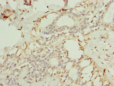 Immunohistochemistry of paraffin-embedded human breast cancer using TMEM154 Antibody at dilution of 1:100Rabbit anti-Human TMEM154 Polyclonal Antibody
