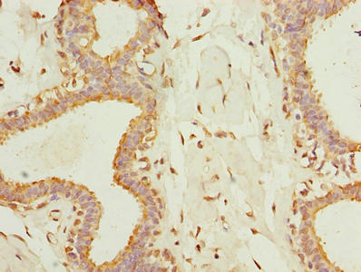 Immunohistochemistry of paraffin-embedded human breast cancer using TMEM161A Antibody at dilution of 1:100Rabbit anti-Human TMEM161A Polyclonal Antibody