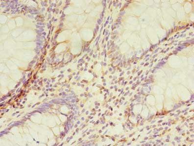 Immunohistochemistry of paraffin-embedded human colon cancer using TMEM165 Antibody at dilution of 1:100Rabbit anti-Human TMEM165 Polyclonal Antibody
