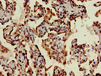 IHC image of TMEM173 Antibody diluted at 1:400 and staining in paraffin-embedded human lung cancer performed on a Leica BondTM system. After dewaxing and hydration, antigen retrieval was mediated by high pressure in a citrate buffer (pH 6.0). Section was blocked with 10% normal goat serum 30min at RT. Then primary antibody (1% BSA) was incubated at 4°C overnight. The primary is detected by a biotinylated secondary antibody and visualized using an HRP conjugated SP system.Rabbit anti-Human TMEM173 Polyclonal Antibody