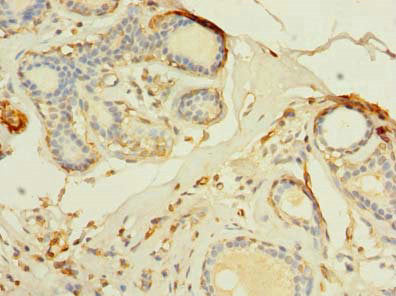 Immunohistochemistry of paraffin-embedded human breast cancer using TMEM176B Antibody at dilution of 1:100Rabbit anti-Human TMEM176B Polyclonal Antibody