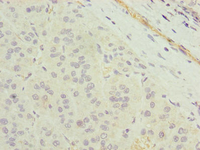 Immunohistochemistry of paraffin-embedded human liver cancer using the antibody at dilution of 1:100Rabbit anti-Human TMEM177 Polyclonal Antibody