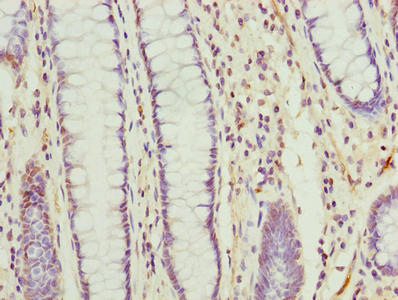 Immunohistochemistry of paraffin-embedded human colon cancer using TMEM177 Antibody at dilution of 1:100Rabbit anti-Human TMEM177 Polyclonal Antibody