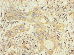 Immunohistochemistry of paraffin-embedded human pancreatic cancer using TMEM184B Antibody at dilution of 1:100Rabbit anti-Human TMEM184B Polyclonal Antibody