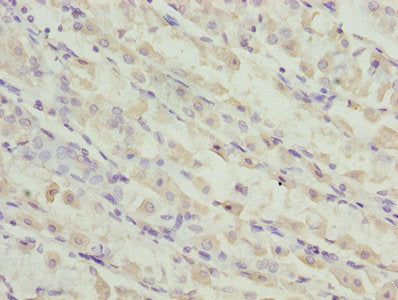 Immunohistochemistry of paraffin-embedded human gastric cancer using TMEM19 Antibody at dilution of 1:100Rabbit anti-Human TMEM19 Polyclonal Antibody