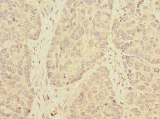 Immunohistochemistry of paraffin-embedded human ovarian cancer using TMEM209 Antibody at dilution of 1:100Rabbit anti-Human TMEM209 Polyclonal Antibody