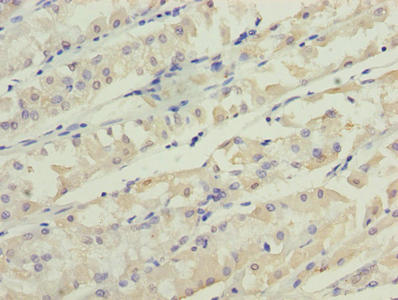 Immunohistochemistry of paraffin-embedded human gastric cancer using TMEM31 Antibody at dilution of 1:100Rabbit anti-Human TMEM31 Polyclonal Antibody