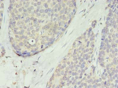 Immunohistochemistry of paraffin-embedded human gastric cancer using the antibody at dilution of 1:100Rabbit anti-Human TMEM45A Polyclonal Antibody