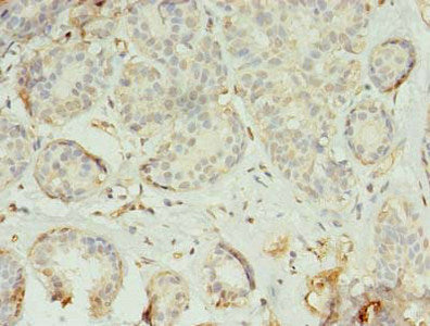 Immunohistochemistry of paraffin-embedded human breast cancer using TMEM45A Antibody at dilution of 1:100Rabbit anti-Human TMEM45A Polyclonal Antibody