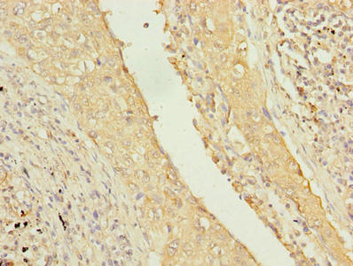 Immunohistochemistry of paraffin-embedded human lung cancer using PIP4P2 Antibody at dilution of 1:100Rabbit anti-Human PIP4P2 Polyclonal Antibody
