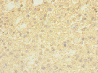 Immunohistochemistry of paraffin-embedded human glioma using the antibody at dilution of 1:100Rabbit anti-Human TMEM56 Polyclonal Antibody