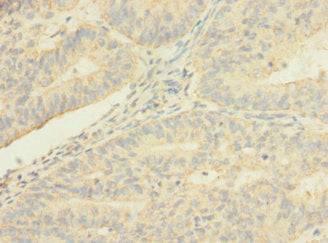 Immunohistochemistry of paraffin-embedded human endometrial cancer using TMEM56 Antibody at dilution of 1:100Rabbit anti-Human TMEM56 Polyclonal Antibody
