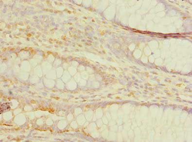 Immunohistochemistry of paraffin-embedded human colon cancer using TMEM59L Antibody at dilution of 1:100Rabbit anti-Human TMEM59L Polyclonal Antibody