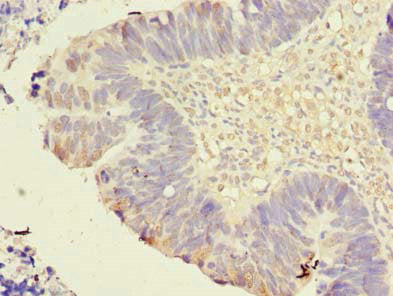 Immunohistochemistry of paraffin-embedded human ovarian cancer using TMEM59L Antibody at dilution of 1:100Rabbit anti-Human TMEM59L Polyclonal Antibody