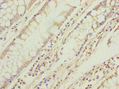 Immunohistochemistry of paraffin-embedded human colon cancer using TMEM71 Antibody at dilution of 1:100Rabbit anti-Human TMEM71 Polyclonal Antibody