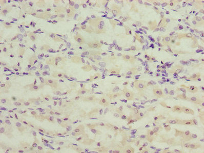 Immunohistochemistry of paraffin-embedded human gastric cancer using TMEM71 Antibody at dilution of 1:100Rabbit anti-Human TMEM71 Polyclonal Antibody