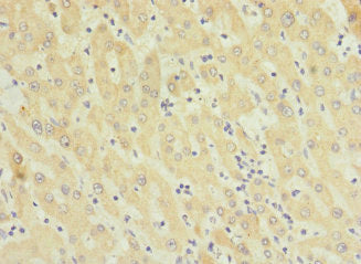 Immunohistochemistry of paraffin-embedded human liver cancer using TMEM91 Antibody at dilution of 1:100Rabbit anti-Human TMEM91 Polyclonal Antibody