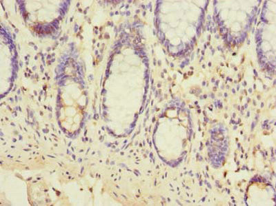 Immunohistochemistry of paraffin-embedded human colon cancer using EMC6 Antibody at dilution of 1:100Rabbit anti-Human EMC6 Polyclonal Antibody