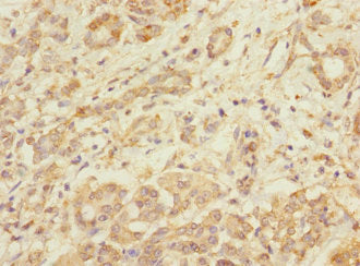 Immunohistochemistry of paraffin-embedded human pancreatic cancer using TMOD1 Antibody at dilution of 1:100Rabbit anti-Human TMOD1 Polyclonal Antibody