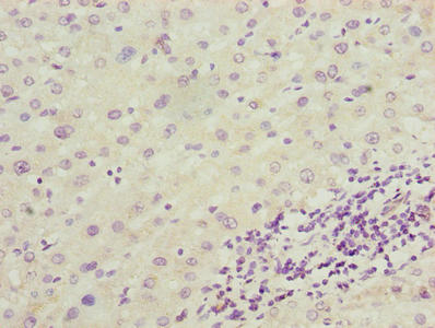 Immunohistochemistry of paraffin-embedded human liver cancer using ENO1 Antibody at dilution of 1:100Rabbit anti-Human ENO1 Polyclonal Antibody