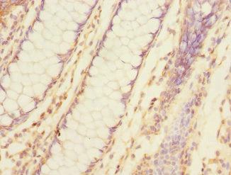 Immunohistochemistry of paraffin-embedded human colon cancer using TNFAIP8 Antibody at dilution of 1:100Rabbit anti-Human TNFAIP8 Polyclonal Antibody