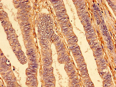 IHC image of TNFRSF10A Antibody diluted at 1:400 and staining in paraffin-embedded human colon cancer performed on a Leica BondTM system. After dewaxing and hydration, antigen retrieval was mediated by high pressure in a citrate buffer (pH 6.0). Section was blocked with 10% normal goat serum 30min at RT. Then primary antibody (1% BSA) was incubated at 4°C overnight. The primary is detected by a biotinylated secondary antibody and visualized using an HRP conjugated SP system.Rabbit anti-Human TNFRSF10A Polyclonal Antibody