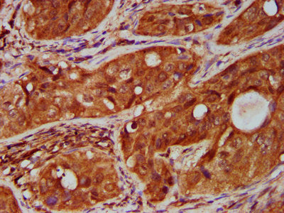 IHC image of the antibody diluted at 1:500 and staining in paraffin-embedded human cervical cancer performed on a Leica BondTM system. After dewaxing and hydration, antigen retrieval was mediated by high pressure in a citrate buffer (pH 6.0). Section was blocked with 10% normal goat serum 30min at RT. Then primary antibody (1% BSA) was incubated at 4°C overnight. The primary is detected by a biotinylated secondary antibody and visualized using an HRP conjugated SP system.Rabbit anti-Human TNFRSF18 Polyclonal Antibody