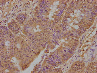 IHC image of TNFRSF1A Antibody diluted at 1:300 and staining in paraffin-embedded human colon cancer performed on a Leica BondTM system. After dewaxing and hydration, antigen retrieval was mediated by high pressure in a citrate buffer (pH 6.0). Section was blocked with 10% normal goat serum 30min at RT. Then primary antibody (1% BSA) was incubated at 4°C overnight. The primary is detected by a biotinylated secondary antibody and visualized using an HRP conjugated SP system.Rabbit anti-Human TNFRSF1A Polyclonal Antibody