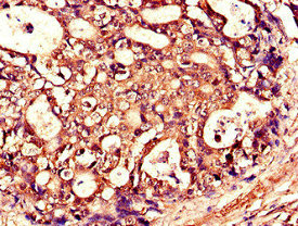 Immunohistochemistry of paraffin-embedded human gastric cancer using the antibody at dilution of 1:100Rabbit anti-Human TNFSF11 Polyclonal Antibody