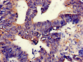 Immunohistochemistry of paraffin-embedded human colon cancer using TNIK Antibody at dilution of 1:100Rabbit anti-Human TNIK Polyclonal Antibody