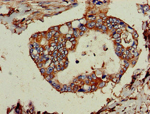 Immunohistochemistry of paraffin-embedded human pancreatic cancer using the antibody at dilution of 1:100Rabbit anti-Human TPD52L2 Polyclonal Antibody