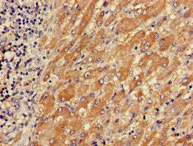 Immunohistochemistry of paraffin-embedded human liver cancer using the antibody at dilution of 1:100Rabbit anti-Human TPM3 Polyclonal Antibody