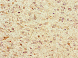 Immunohistochemistry of paraffin-embedded human glioma using TPPP Antibody at dilution of 1:100Rabbit anti-Human TPPP Polyclonal Antibody