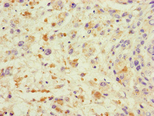 Immunohistochemistry of paraffin-embedded human melanoma using the antibody at dilution of 1:100Rabbit anti-Human TRAF2 Polyclonal Antibody