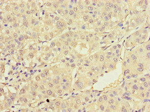 Immunohistochemistry of paraffin-embedded human liver cancer using TRAF2 Antibody at dilution of 1:100Rabbit anti-Human TRAF2 Polyclonal Antibody