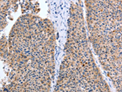 The image on the left is immunohistochemistry of paraffin-embedded Human liver cancer tissue using TAT Antibody(TAT Antibody) at dilution 1/35, on the right is treated with fusion protein. (Original magnification: ×200)Rabbit anti-Human TAT Polyclonal Antibody