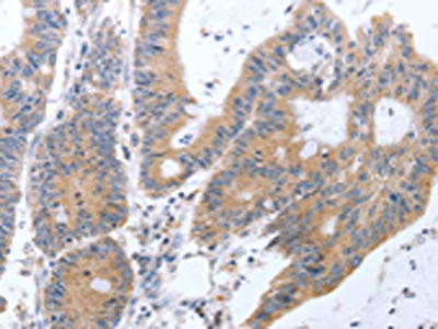 The image on the left is immunohistochemistry of paraffin-embedded Human colon cancer tissue using the antibody Antibody) at dilution 1/35, on the right is treated with fusion protein. (Original magnification: ×200)Rabbit anti-Human TAT Polyclonal Antibody