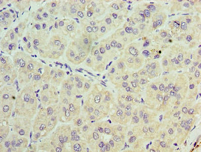 Immunohistochemistry of paraffin-embedded human liver cancer using the antibody at dilution of 1:100Rabbit anti-Human TRBC1 Polyclonal Antibody