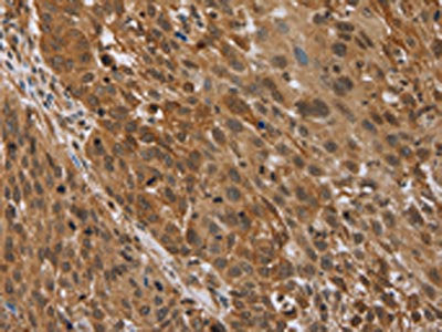 The image on the left is immunohistochemistry of paraffin-embedded Human lung cancer tissue using STMN2/STMN3/STMN4 Antibody(STMN2/STMN3/STMN4 Antibody) at dilution 1/45, on the right is treated with synthetic peptide. (Original magnification: ×200)Rabbit anti-Human STMN2/STMN3/STMN4 Polyclonal Antibody