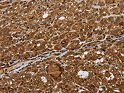 The image on the left is immunohistochemistry of paraffin-embedded Human thyroid cancer tissue using the antibody Antibody) at dilution 1/45, on the right is treated with synthetic peptide. (Original magnification: ×200)Rabbit anti-Human STMN2/STMN3/STMN4 Polyclonal Antibody