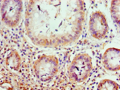 Immunohistochemistry of paraffin-embedded human colon cancer using TRIM27 Antibody at dilution of 1:100Rabbit anti-Human TRIM27 Polyclonal Antibody