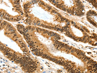 The image on the left is immunohistochemistry of paraffin-embedded Human colon cancer tissue using RUNX3 Antibody(RUNX3 Antibody) at dilution 1/25, on the right is treated with synthetic peptide. (Original magnification: ×200)Rabbit anti-Human RUNX3 Polyclonal Antibody