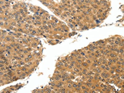 The image on the left is immunohistochemistry of paraffin-embedded Human breast cancer tissue using the antibody Antibody) at dilution 1/25, on the right is treated with synthetic peptide. (Original magnification: ×200)Rabbit anti-Human RUNX3 Polyclonal Antibody