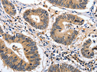 The image on the left is immunohistochemistry of paraffin-embedded Human colon cancer tissue using MSH3 Antibody(MSH3 Antibody) at dilution 1/20, on the right is treated with fusion protein. (Original magnification: ×200)