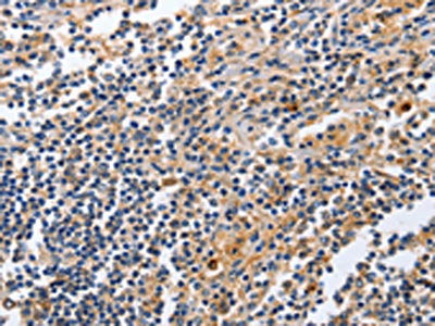 The image on the left is immunohistochemistry of paraffin-embedded Human tonsil tissue using the antibody Antibody) at dilution 1/20, on the right is treated with fusion protein. (Original magnification: ×200)
