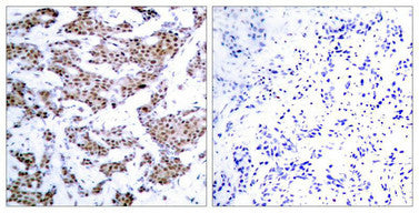Immunohistochemical analysis of paraffin-embedded human breast carcinoma tissue using MEF2A(Phospho-Thr312) Antibody(left) or the same antibody preincubated with blocking peptide(right).