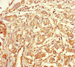 Immunohistochemistry of paraffin-embedded human pancreatic cancer using TSPAN7 Antibody at dilution of 1:100Rabbit anti-Human TSPAN7 Polyclonal Antibody